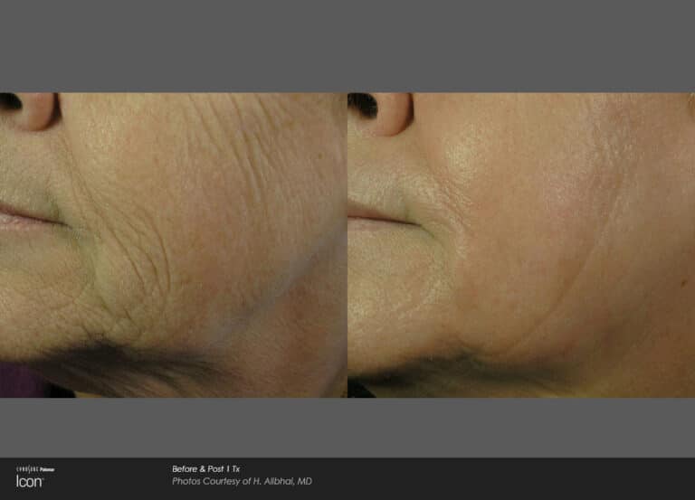 Fractional Laser Resurfacing Rockville Md Olsen Aesthetics