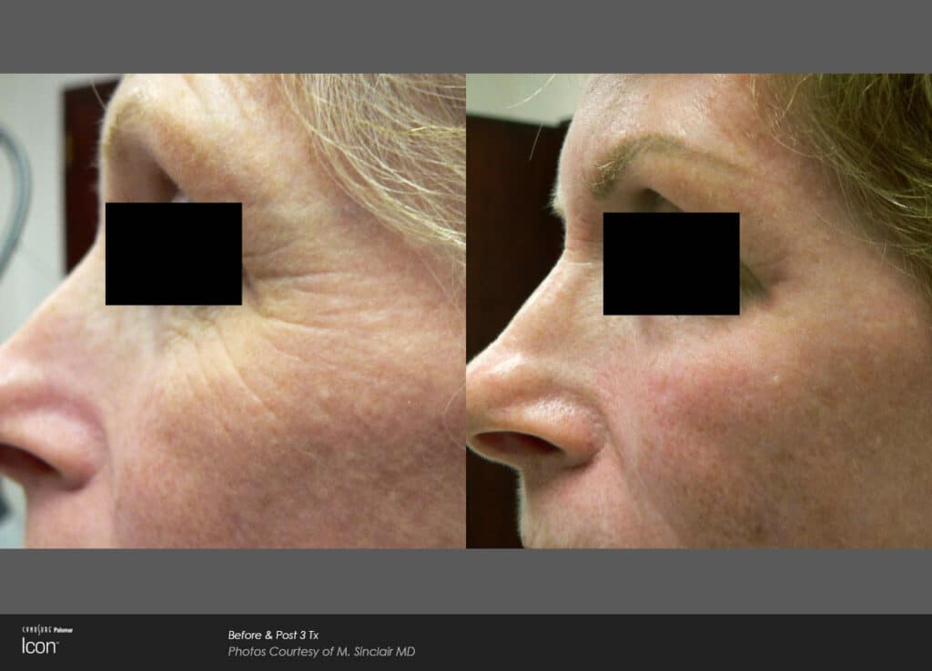 Fractional Laser Resurfacing In Rockville MD | Scar Revision Bethesda MD