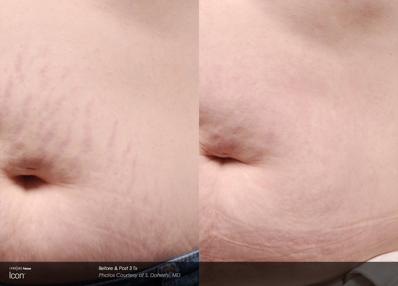 stretch mark before after 1