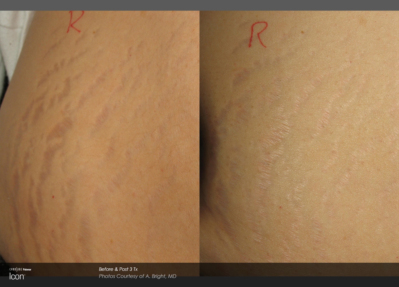 stretch mark before after 2 1 1