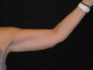 After Image: Coolsculpting – Arms
