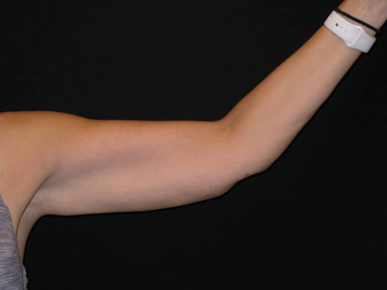 After Image: Coolsculpting – Arms - front