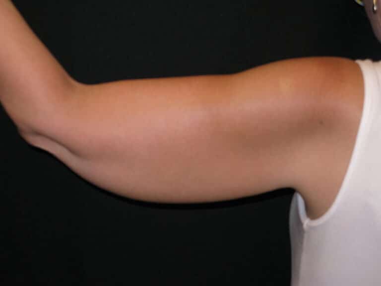 Before Image: Coolsculpting – Arms -