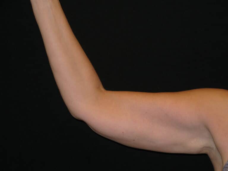 After Image: Coolsculpting – Arms -