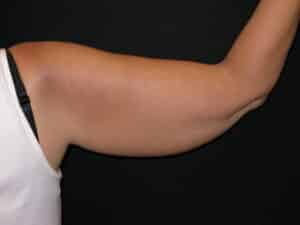 Before Image: Coolsculpting – Arms