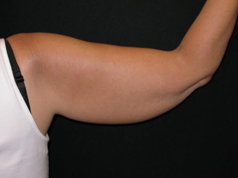 Before Image: Coolsculpting – Arms - front