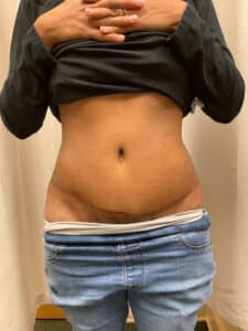 After Image: Coolsculpting – Abdomen