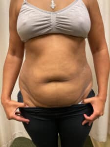Before Image: Coolsculpting – Abdomen