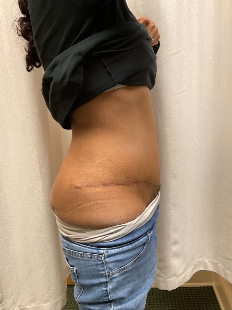 After Image: Coolsculpting – Abdomen - right-side
