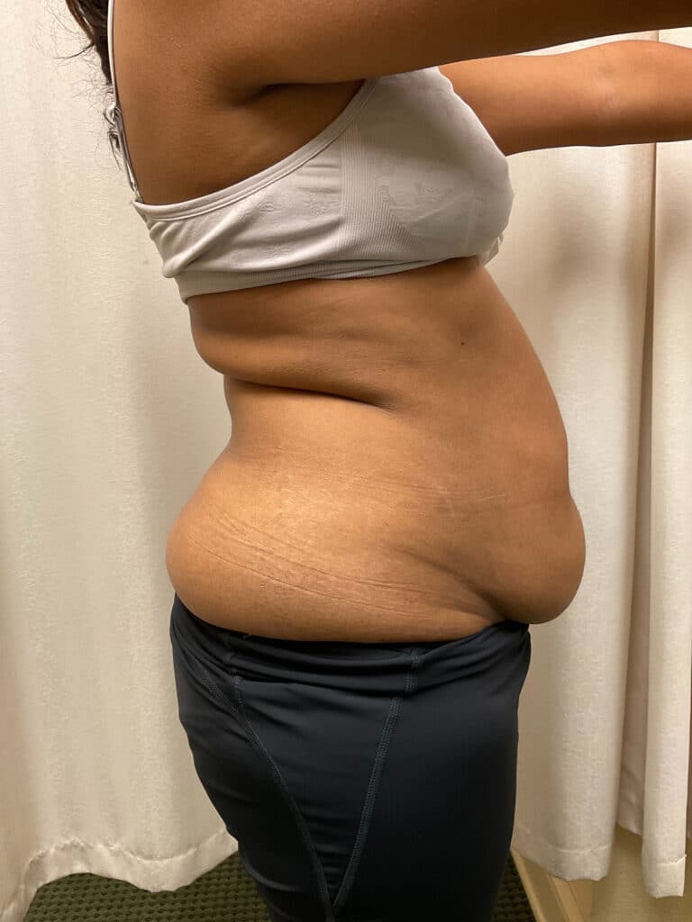 Before Image: Coolsculpting – Abdomen - right-side