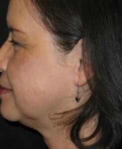 After Image: Coolsculpting – Neck