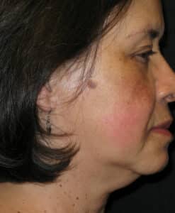 Before Image: Coolsculpting – Neck