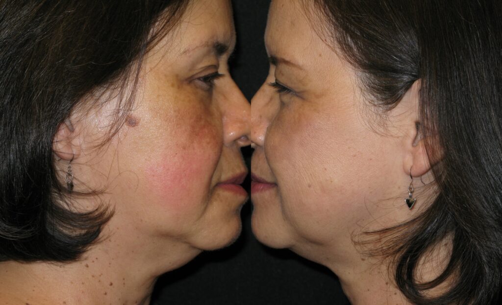 coolsculpting neck