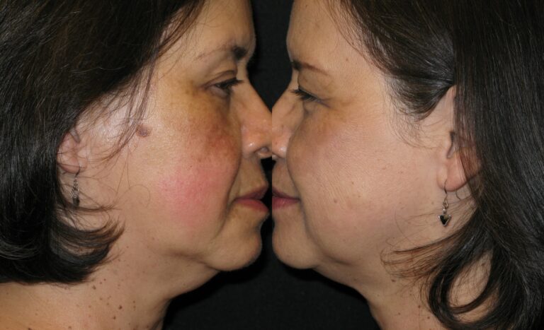 coolsculpting neck