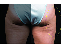 Coolsculpting – Lateral Thighs/Banana Rolls