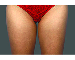 Coolsculpting – Inner Thighs