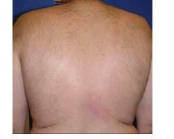 Hair Removal Case ID: 1723