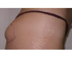 Coolsculpting of buttock deformity after injury